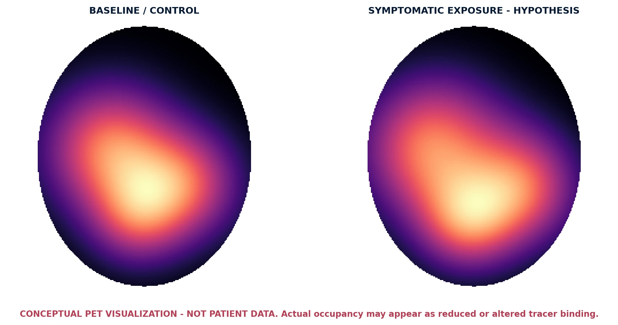 Conceptual baseline-versus-symptomatic PET visualization illustrating the prediction of a measurable change in cortical 5-HT2A binding or occupancy metrics.